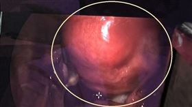 透過子宮鏡的輔助可看到子宮肌瘤。（圖／烏日林新醫院提供）