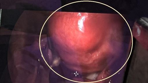 45萬女性子宮肌瘤 醫示警1事不理恐心衰竭