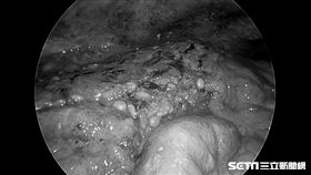 大腸破4cm洩出兩碗公糞便／黃漢斌醫師提供