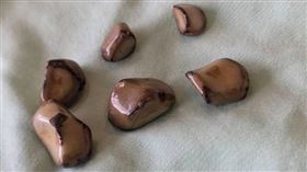 李博彰醫師指出，先天膽道異常而造成後天膽結石產生，只能透過高階電腦斷層或是核磁共振掃描膽道，才能檢查出來總膽管和膽囊管是否有異常。圖為患者取出6顆膽結石。（圖／中醫大新竹附醫提供）