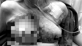 乳房有潰瘍，塗草藥偏方，台中44歲女「栗子腫成釋迦大」拖延就醫，乳癌末期轉移，標靶治療(圖／翻攝畫面)