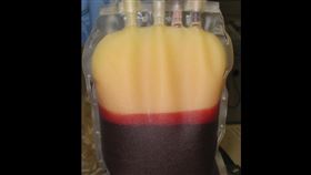 乳糜血(香港紅十字會輸血服務中心提供)