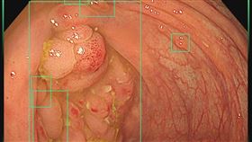 醫師替患者照大腸鏡，於盲腸處發現有如鵝卵石般的多發性息肉狀病兆。（圖／翻攝自胃腸專家 葉秉威醫師粉專）