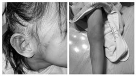 新北市瑞芳區某幼兒園傳出虐童事件，一名劉姓父親控訴，3歲的女兒領有身心障礙者手冊，2日晚間發現女兒臉頰、雙耳和雙腿有多處不明瘀青