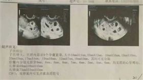 ▲江蘇省南昌市一名25歲侯姓女子，竟懷上「9胞胎」（圖／翻攝微博）