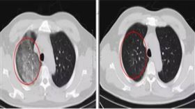 陸爆罕見人畜傳染病「Q熱」 憂成新冠第二