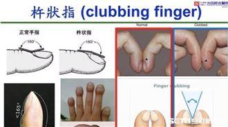 手指頭變「杵狀指」　權威醫：是肺癌警訊