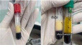酗酒患者抽血上面浮一層油，俗稱「牛奶血」。（圖／翻攝Tiktok@moli_moo）
