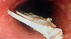 吃魚做1事慘了！醫曝恐怖畫面示警網嚇壞