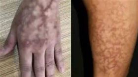 中國蘇州一名婦人手、腳都長出黑紅色「蟒蛇紋」，十分嚇人。（圖／翻攝自新聞晨報）