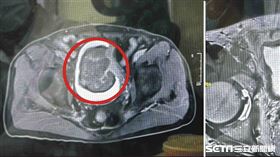 皮癌三期／彰基院方提供