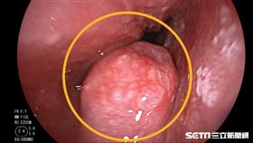 食道癌／南投醫院提供
