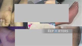 緬甸詐騙園區監禁全球6000人，中國博士也受困，下身被打到黑爛腫脹。（圖/翻攝泰國報導者）