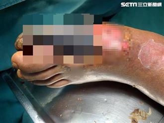 老翁剪腳指甲腳掌全黑　醫嘆:再晚得截肢