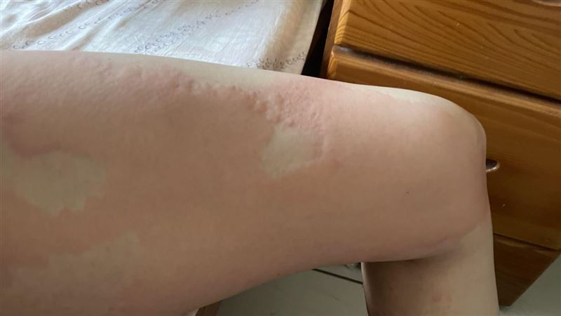 別再誤會海鮮！「蕁麻疹」元凶曝:3招治好