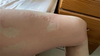 別再誤會海鮮！「蕁麻疹」元凶曝:3招治好