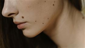 痣不只影響美觀，還可能對身體造成影響。（示意圖／翻攝自Pexels）