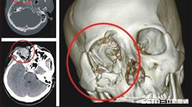 彰化男玩鞭炮一眼失明／彰基提供