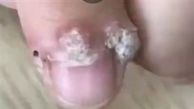 吳姓女子做完美甲後，發現指縫間長出透明小包，不痛不癢卻越長越大，確認是因HPV病毒感染所致。（圖／翻攝自微博）