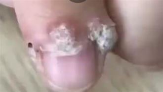 做美甲竟感染HPV指緣長出菜花　醫曝原因