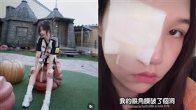 Ashly受傷慘變獨眼龍。（圖／翻攝自Ashly IG）