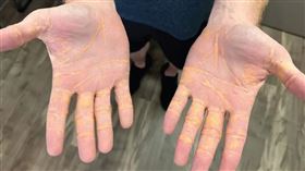 一位40多歲男子長期吃肉、乳製品，最終手部不斷流黃汁。（圖／翻攝自JAMA Cardiology）

