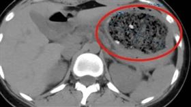 中國女大生愛吃糖炒山楂，不料竟吃出胃結石。（圖／翻攝自微博）