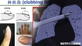 杵狀指、肺癌