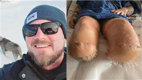 阿姆斯壯露營手指燙傷感染敗血症，雙腿截肢仍不減他對登山的熱情。（圖／翻攝Max Armstrong臉書）