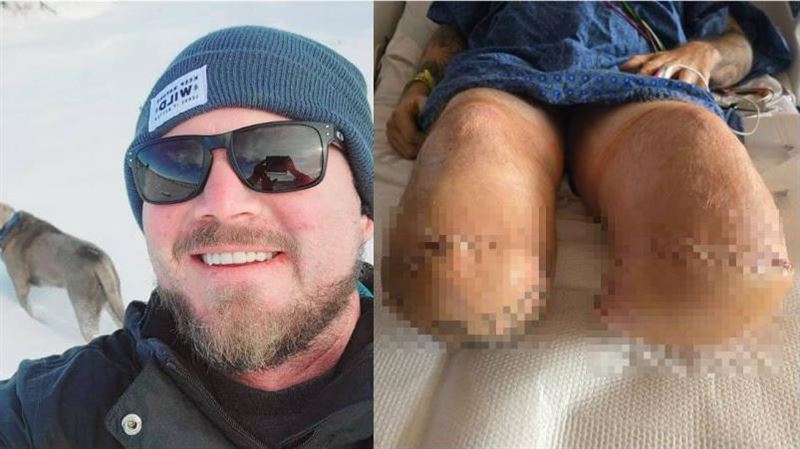 男野炊燙傷敗血症截肢　誓用義肢爬山登頂