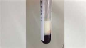 6週大寶寶發燒就醫，竟抽出「整管牛奶血」。（圖／翻攝自浙江大學醫學院附屬兒童醫院網站）