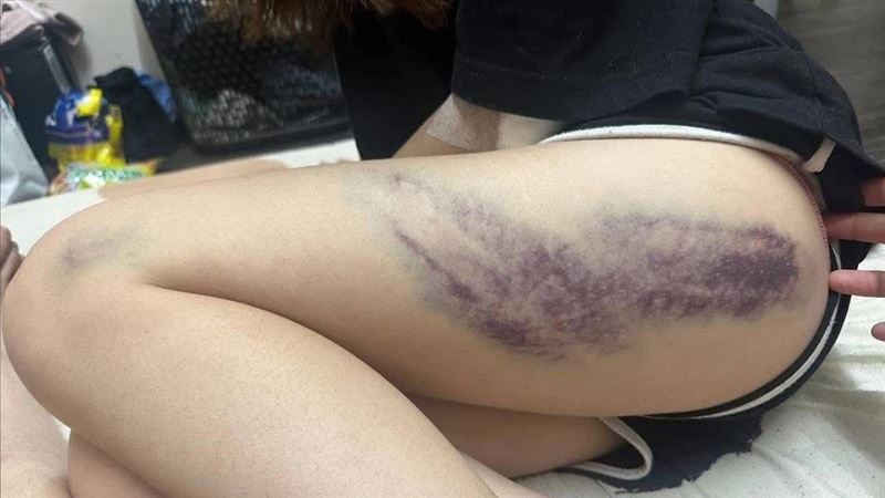 彰網紅直播主遭控　持球棒毆打女友全身傷