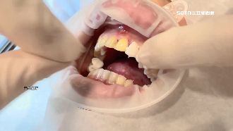 獨／假冒牙技師　害患者牙神經外露發炎