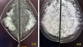 陳女士的乳房攝影圖(左圖)對比健康的乳房攝影(右圖)充滿鈣化和發炎組織。（圖／長安醫院提供）