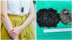 高雄,膽結石,魚子醬,高醫岡山醫院