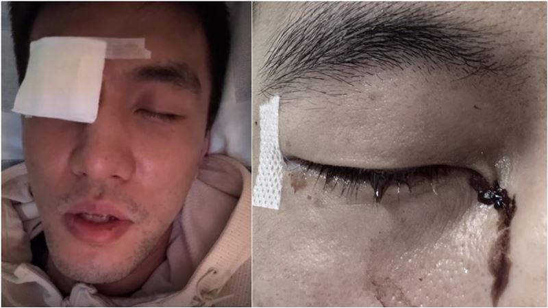 CBA球星結膜破碎　絕望喊：毁了我一輩子