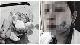 泰國一名女子希望擁有一對迷人的酒窩，未料術後右臉頰傷口持續出血，時間甚至長達2個月，讓她一度暈死。（圖／翻攝自 ต้นอ้อ เป็นหนึ่ง臉書）