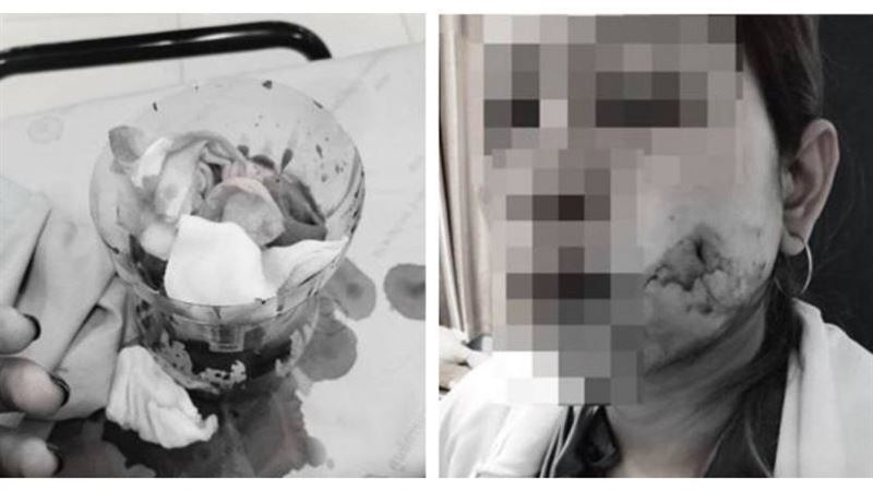 泰女花2233元酒窩整形　術後血流不止暈死