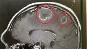 63歲男病患，腳無力走路歪斜，竟是肺癌，腦腫瘤轉移，長安醫院神經外科副院長李漢忠(圖／長安醫院提供)