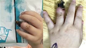 ▲醫師提醒，錯誤包紮方式恐導致手指壞死。（圖／翻攝自Do醫生微博）

