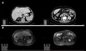 肝硬化換肝竟變肝癌末期　醫師揭恐怖真相（圖／翻攝FB)
