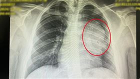 健檢X光異常，驚見12公分惡性腫瘤 17歲少年罹罕癌，零症狀，(圖／中港澄清醫院提供)
