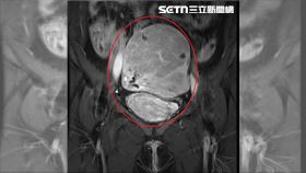 2寶媽患子宮肌腺經痛如刀割　醫靠1招解決(圖/翻攝畫面)