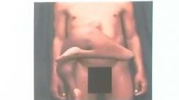 印度少年腹部「長2條腿」 醫：全球僅42例