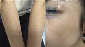 大陸浙江一名女子因為頭髮稀疏，過量使用生髮液，導致額頭、臉頰、唇周以及手臂上的汗毛都長了出來。（圖／抖音）