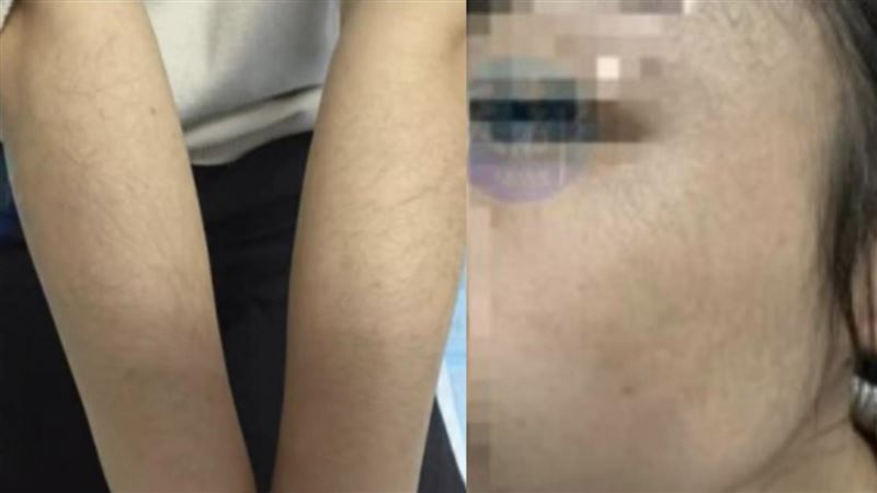 她狂用生髮水！半個月「全臉汗毛」傻眼了