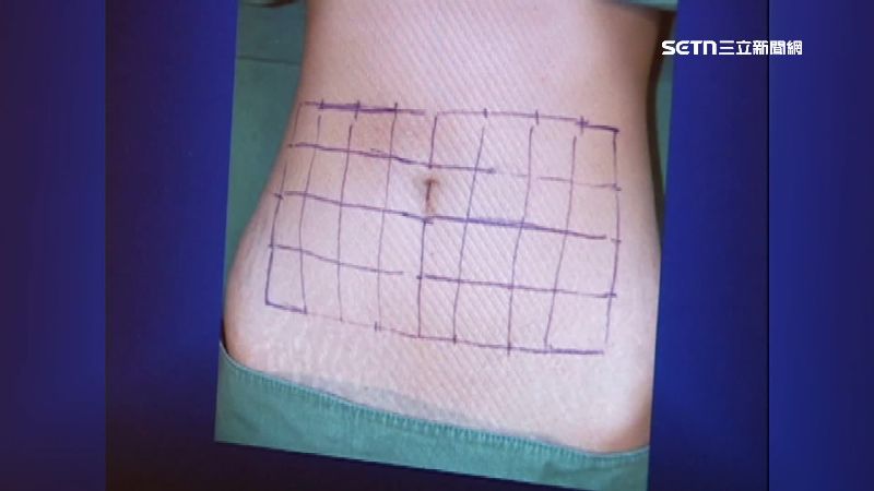 砸錢打消脂針害脂肪壞死　女腹部潰爛開刀