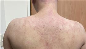 患者小戴兼異膚炎精準治療前，皮膚經常搔癢破皮流血、背部更是「滿目瘡痍」。（圖／大林慈濟醫院提供）