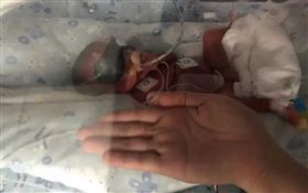 湖南岳陽一名女子懷雙胞胎，其中一個是罕見的「超低早產兒」。（圖／翻攝自極目新聞）