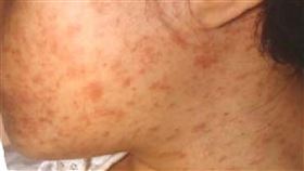 新北麻疹病例持續增加　監測期接觸者逾千人國內麻疹感染個案持續增加，新北市截至6日已累計27例麻疹確診個案，目前仍於監測期接觸者尚有1011人。圖為麻疹患者皮疹症狀。（新北衛生局提供）中央社記者王鴻國傳真　108年5月7日